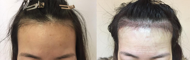 Asian_HairTransplant_Front
