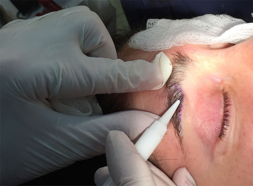 The single hair follicle is meticulously inserted at the same angle as the original eyebrow hair.