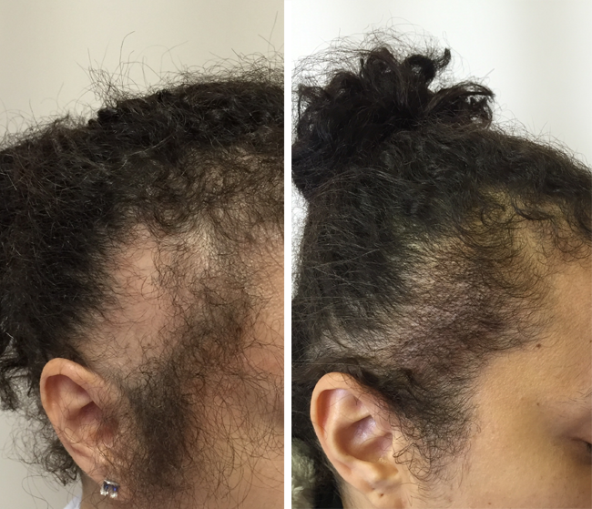 Hair Straightener Damage Repaired - International Hair Surgical Group