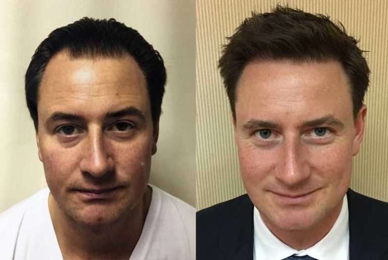 Hair Transplant New Jersey (NJ) John Schwinning, MD FUE and FUT Hair Restoration New York, NY