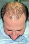 Patient with prior plug style hair transplant