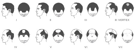 Male Pattern Baldness Treatment in Edison NJ | Dr. John Schwinning
